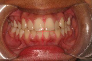 Before Teen Underbite Smile Image