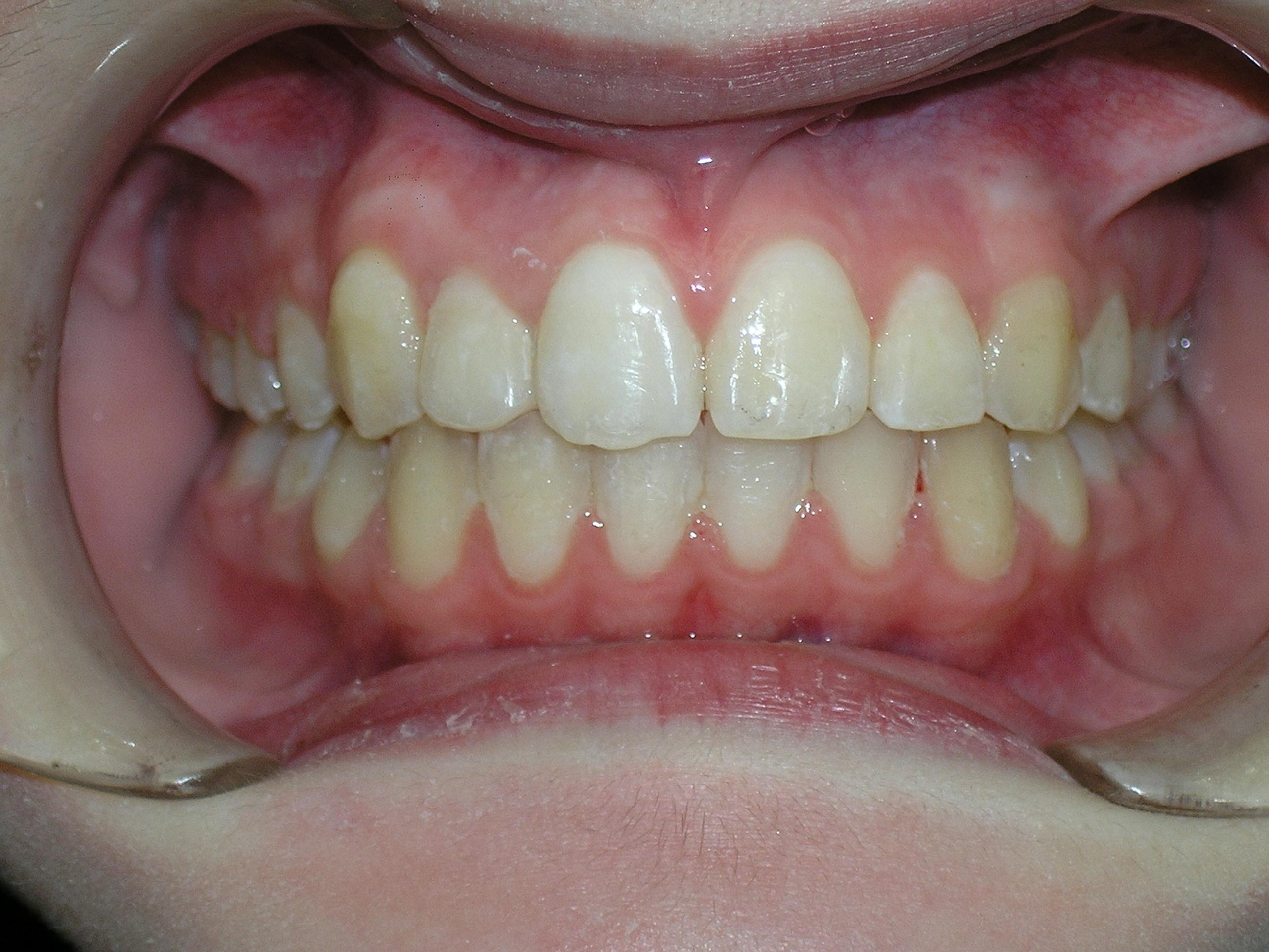 Cκ treatment of underbite