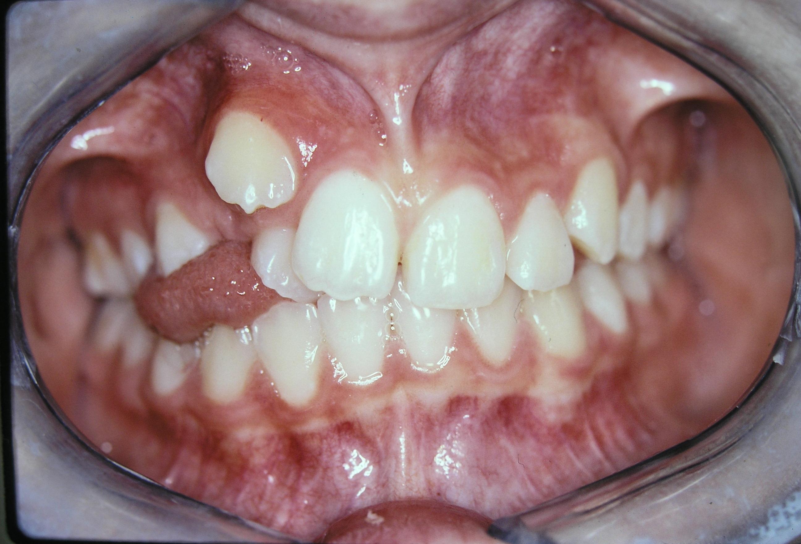 Cǰ Teen Underbite Smile Image