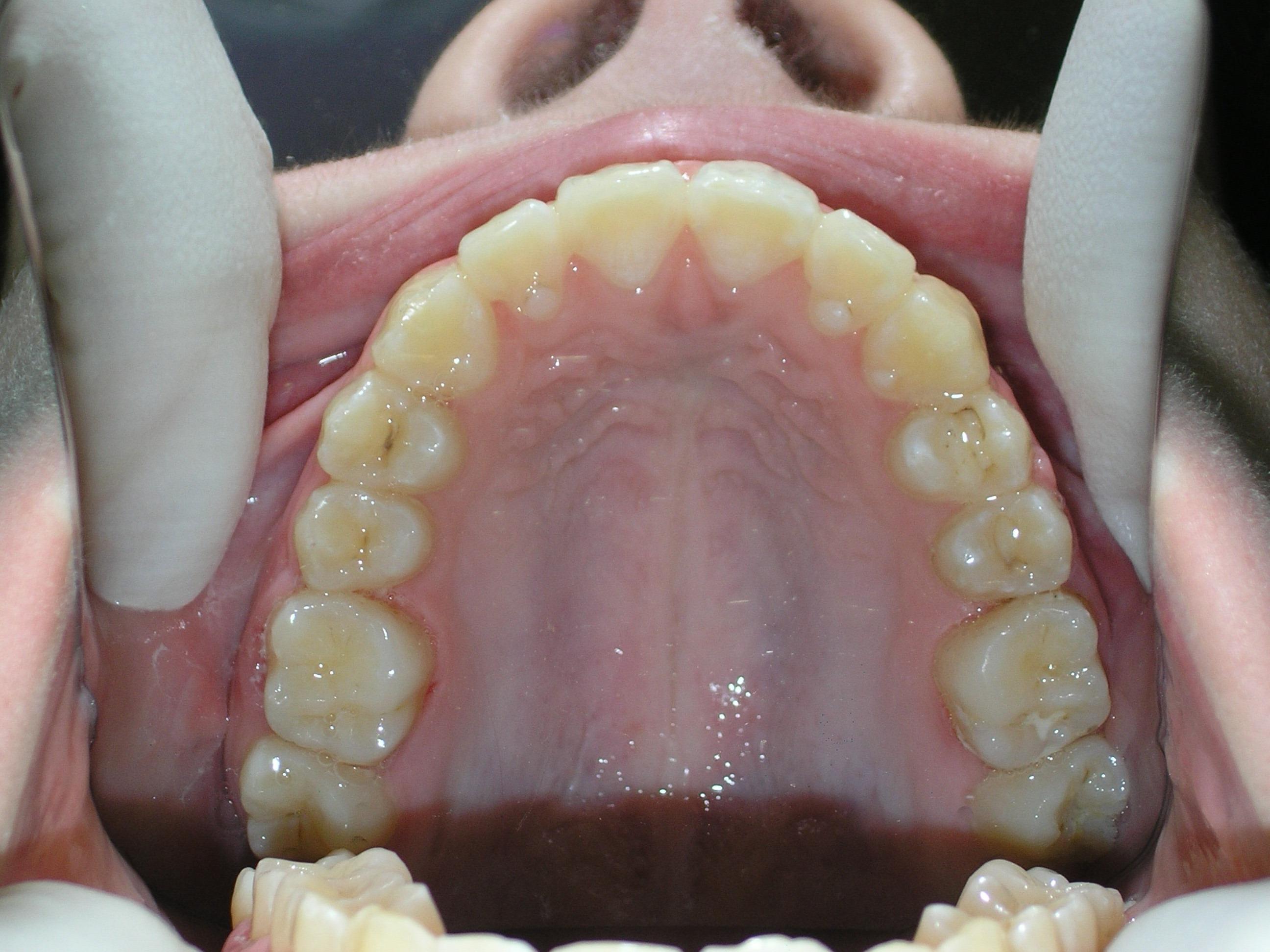 Cκ treatment of underbite