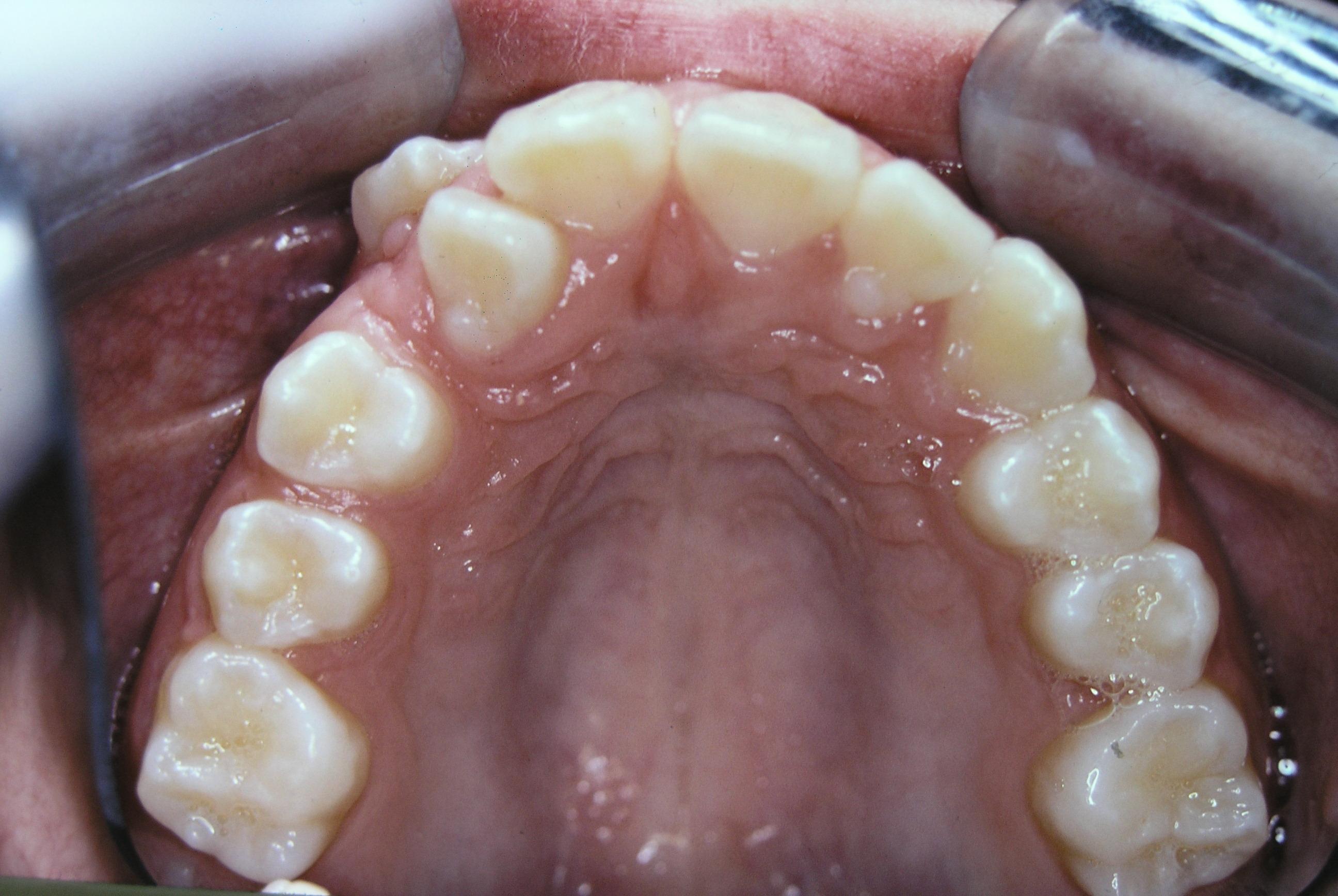 Before treatment With underbite Teeth Image