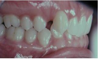 Cǰ Teen Underbite Smile Image