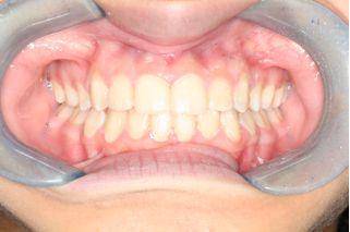 After treatment of underbite