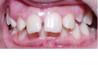 Cǰ treatment With underbite Teeth Image