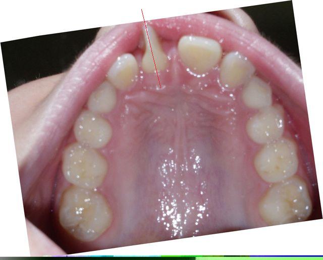 Before Teen Underbite Smile Image