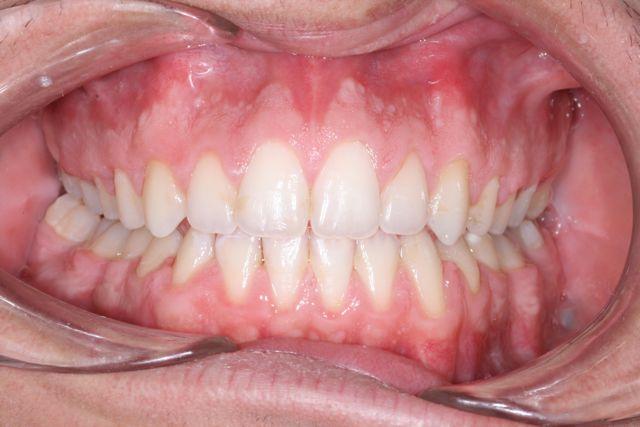 After treatment of underbite