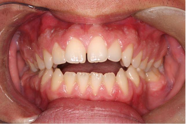 Before treatment With underbite Teeth Image