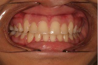 After treatment of underbite