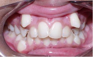 Before treatment With underbite Teeth Image