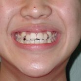 Cǰ Teen Underbite Smile Image