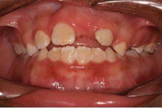 Cǰ Teen Underbite Smile Image