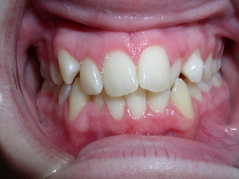 Cǰ treatment With underbite Teeth Image