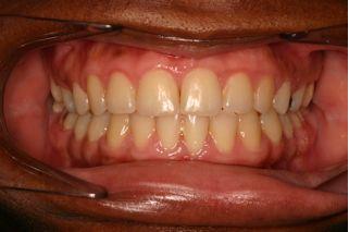 After treatment of underbite