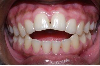 Cǰ treatment With underbite Teeth Image