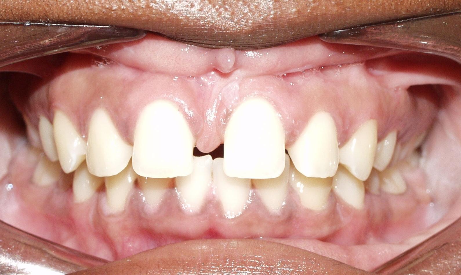 Before Teen Underbite Smile Image