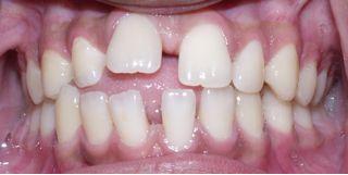 Cǰ Teen Underbite Smile Image