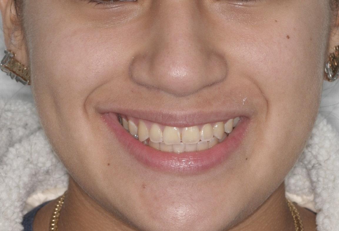 After Smile Image