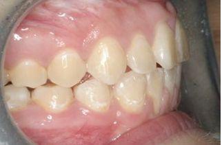 After treatment of underbite